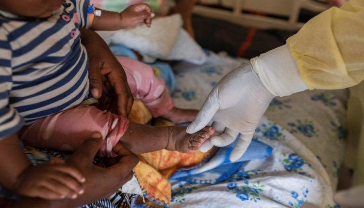 جدري القردة يودي بحياة 548شخصا بالكونغو