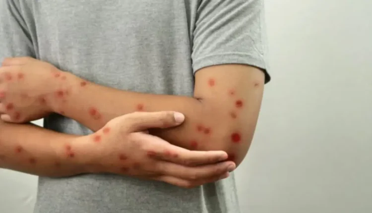 الحصبة (بوحمرون)